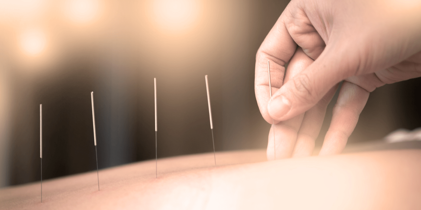Acupunture needles in back